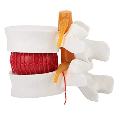 Afbeelding van Human Lumbar Disc Herniation Model, Fydun 1:1.5 Demonstratie Model van Vertebral Spine