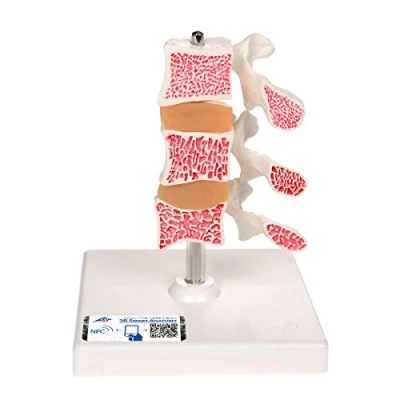 Afbeelding van Anatomisch model 3B Osteoporose lendenwervelkolom doorsneden
