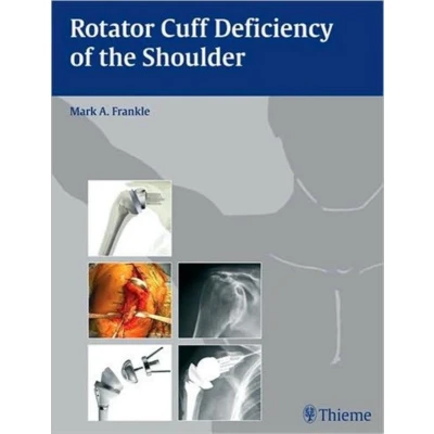 Afbeelding van Rotator Cuff Deficiency of the Shoulder